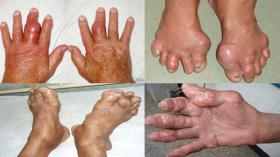 Nguyên nhân cách chữa bệnh gout khỏi lâu dài