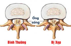 XẸP CỘT SỐNG CHỮA THẾ NÀO MỚI HIỆU QUẢ