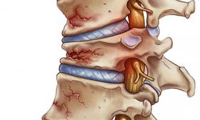 Lún đốt sống nguyên nhân cách chữa