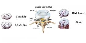 Rách bao xơ đĩa đệm Nguyên nhân, cách điều trị 