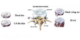 Rách vòng xơ đĩa đệm Nguyên nhân, cách điều trị