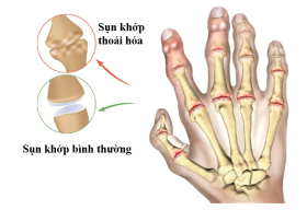 Chữa đau nhức xương khớp bàn tay, ngón tay thế nào