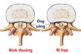 Hẹp ống sống chữa thế nào mới hiệu quả