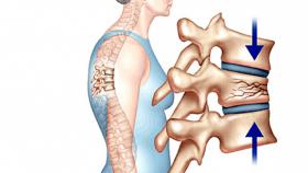 Xẹp đốt sống: Nguyên nhân, triệu chứng, chẩn đoán và điều trị