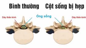 Nguyên nhân hẹp cột sống và cách chữa hẹp cột sống